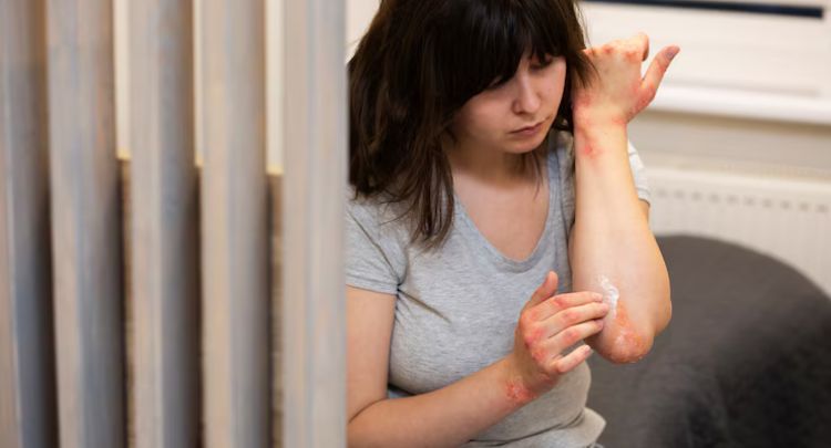 Eczema-Blog-Image